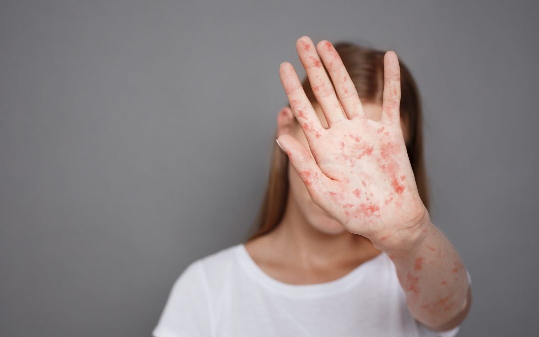 How Contagious is Measles?