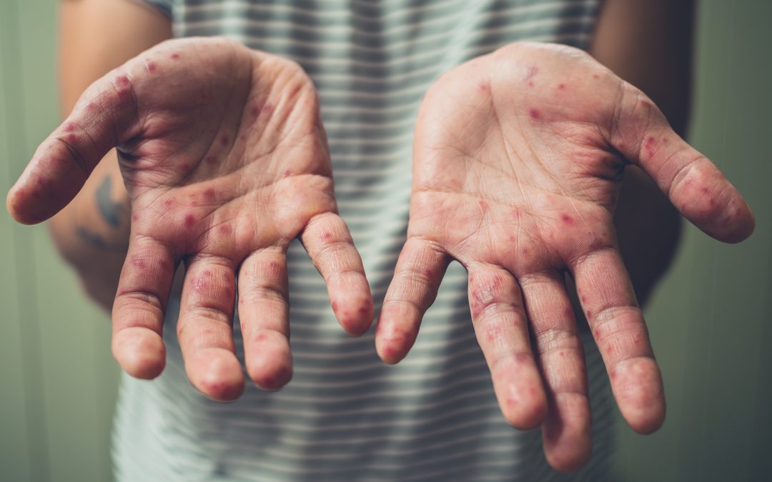 Can Adults Get Measles, or Is It Just Found in Kids?